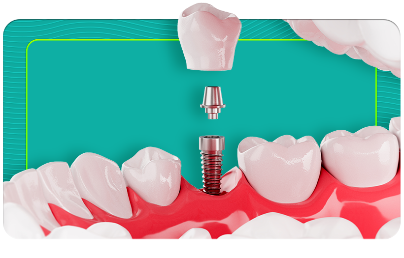 We recommend permanent and uninterrupted comfort with implants and professional applications