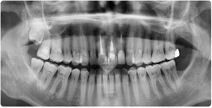 X ray taraması